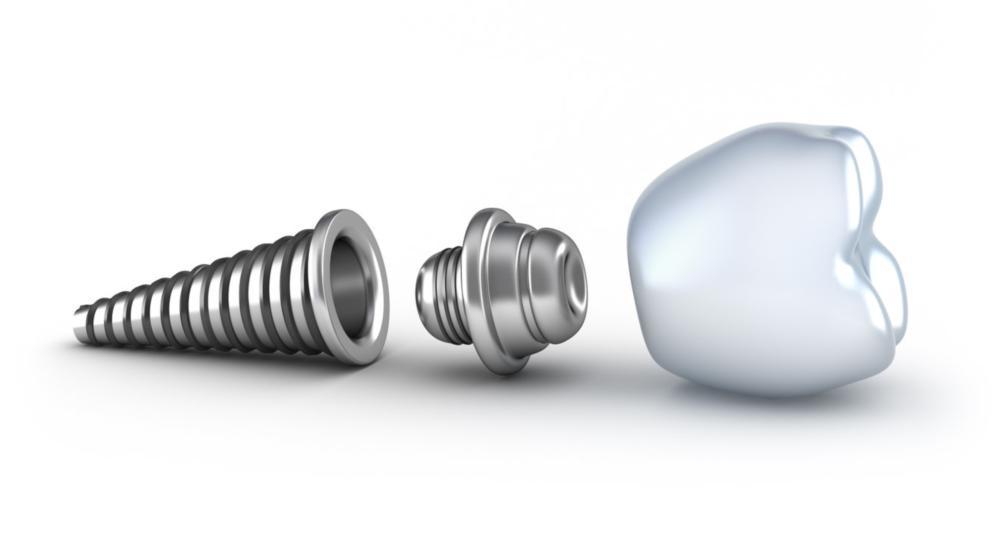 dental implant in Aurora il