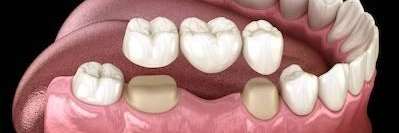 An Illustration of a Dental Crown in Aurora, IL