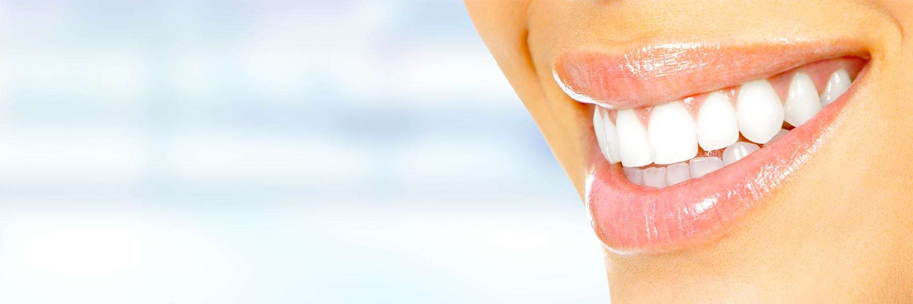 Lady's teeth after whitening in Aurora. IL