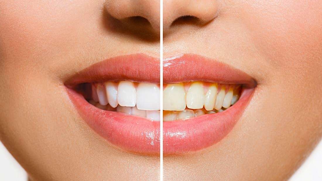 What Is the Side Effect of Teeth Whitening? Teeth Whitening Aurora IL