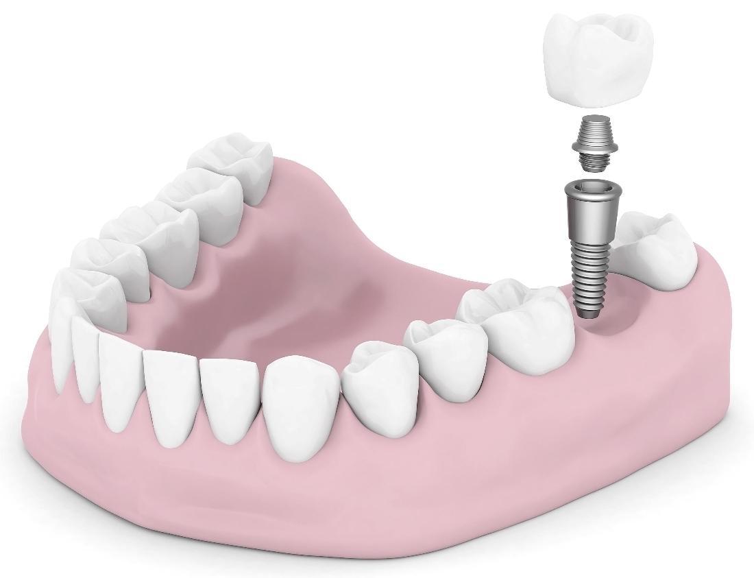 Aurora IL Dentist What Is the Dental Implant Process?