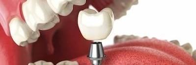 Dental Implant Illustration in Aurora, IL