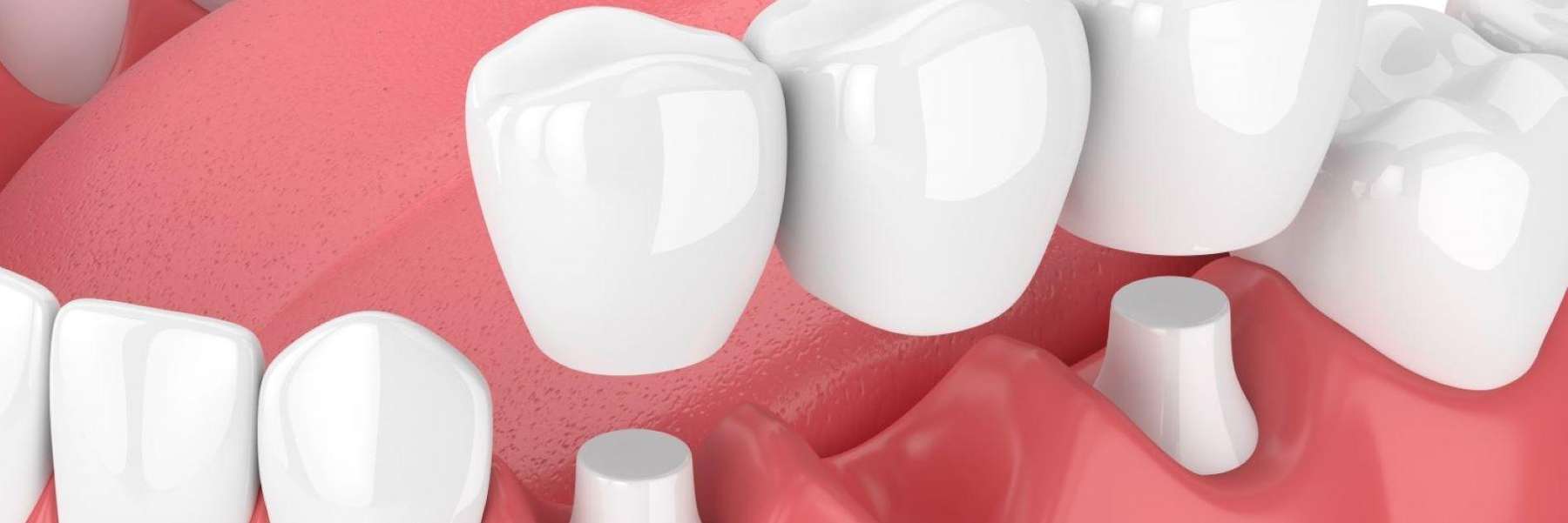 An illustration of dental bridge repair in Aurora, IL