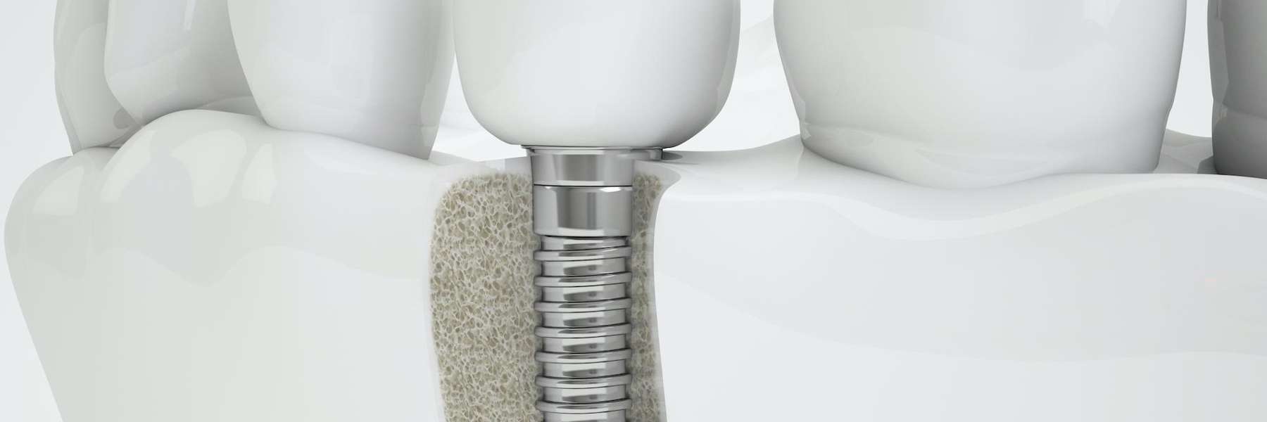 An illustration of a dental implant at Prairie Dental Care