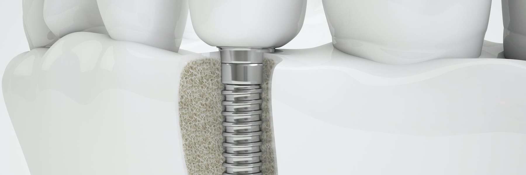 An illustration of a dental implant in Aurora, IL