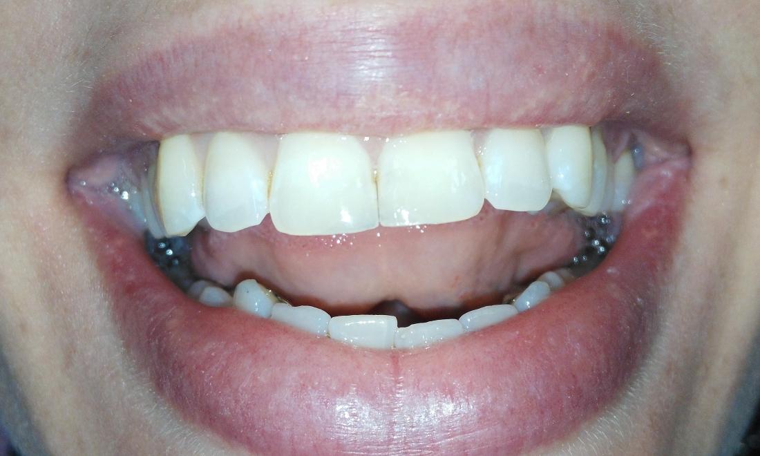 Tooth-colored resin fix chipped front teeth | Prairie Dental Care