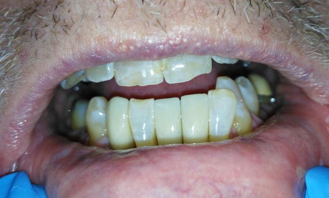 Dental implants for bottom front teeth | Prairie Dental Care