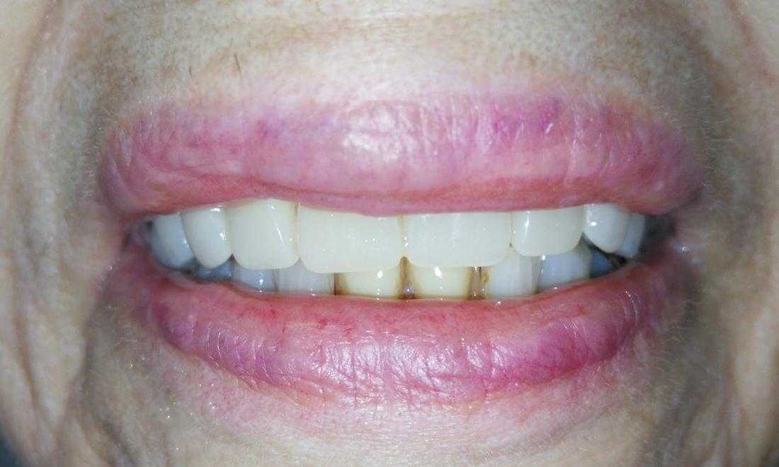 Full upper denture to replace front teeth | Dentist Aurora IL