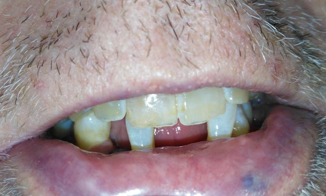 Missing lower front teeth | Dentist Aurora IL