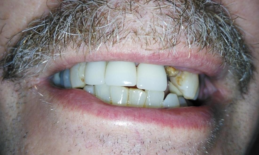 Fractured upper front tooth | Dentist Aurora IL